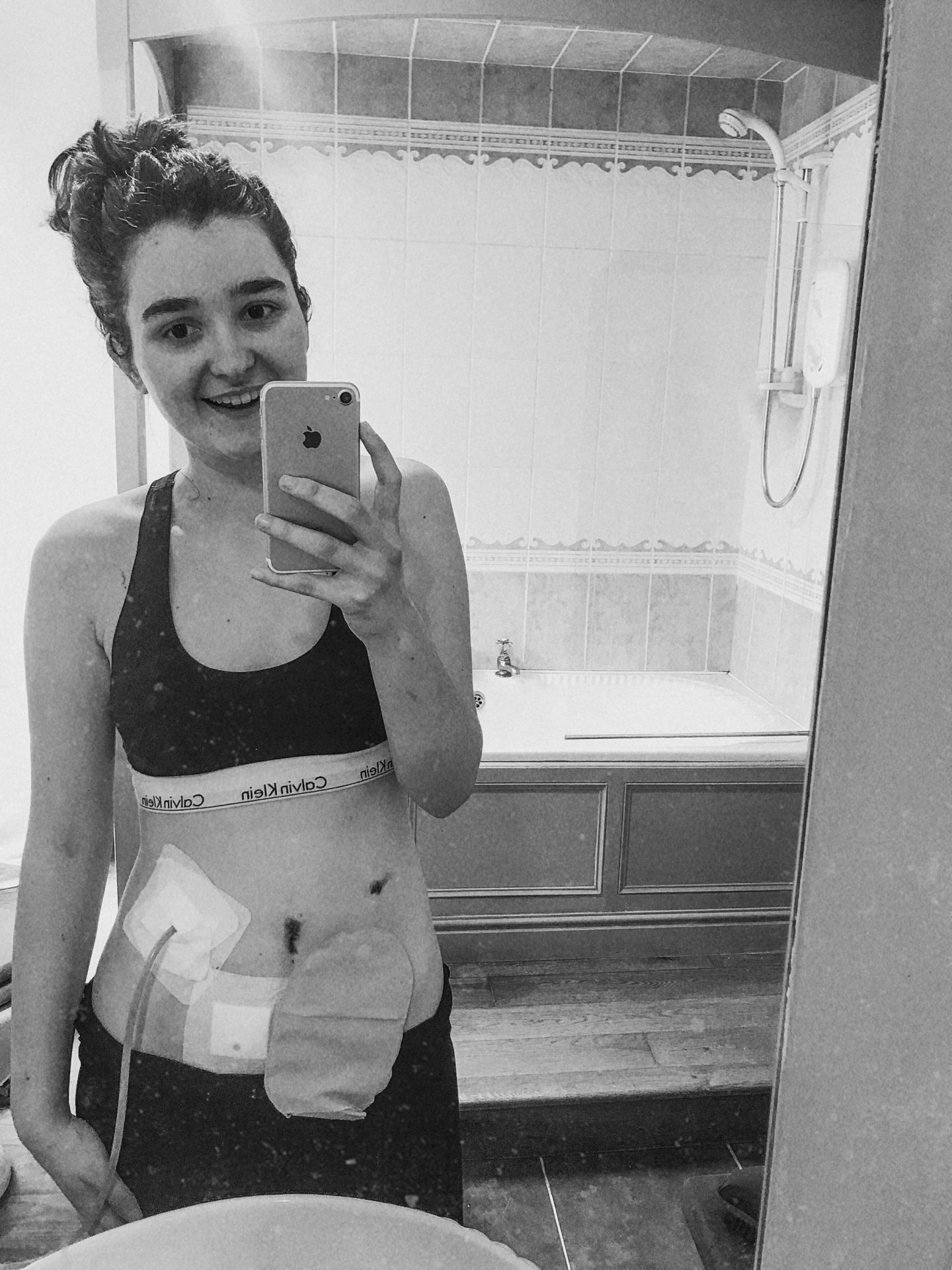 Why I made my stoma permanent j-pouch vs barbie butt surgery